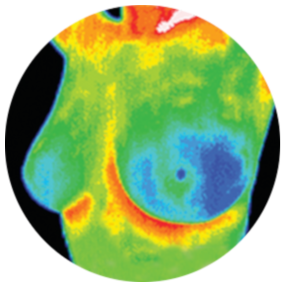 breast thermography